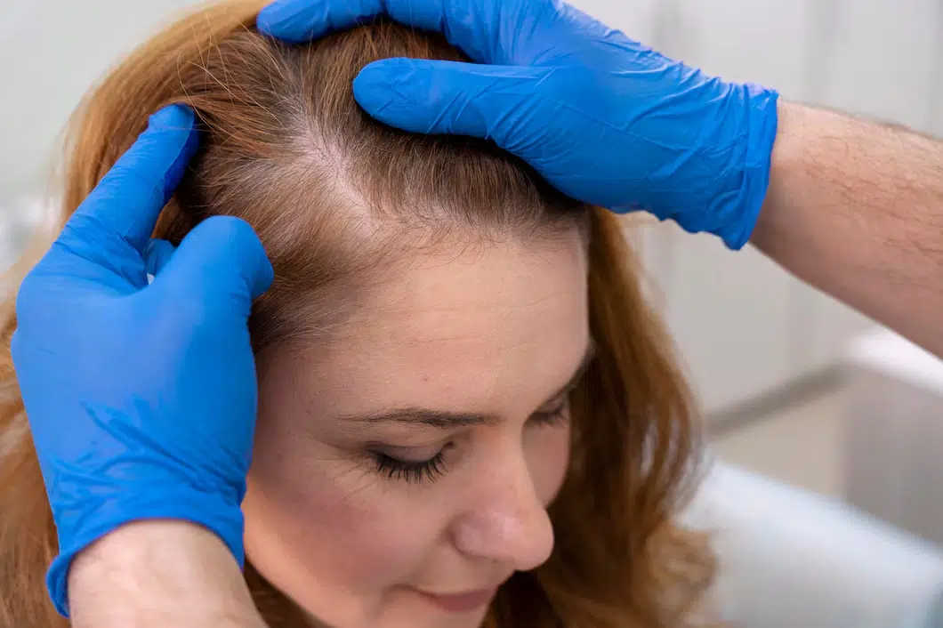 Hair Transplants for Women