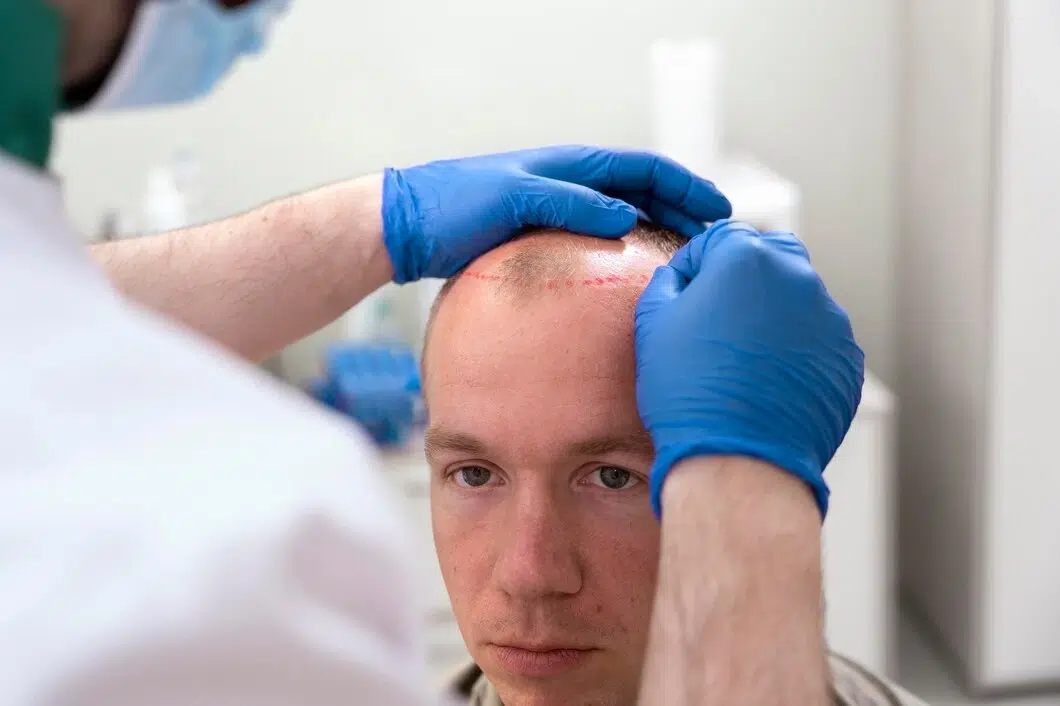 Hairline Transplant