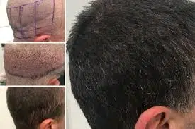 Hair Transplant for Scar Repair