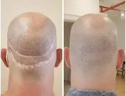 Hair Transplant for Scar Repair