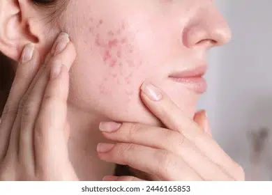 Acne Scarring