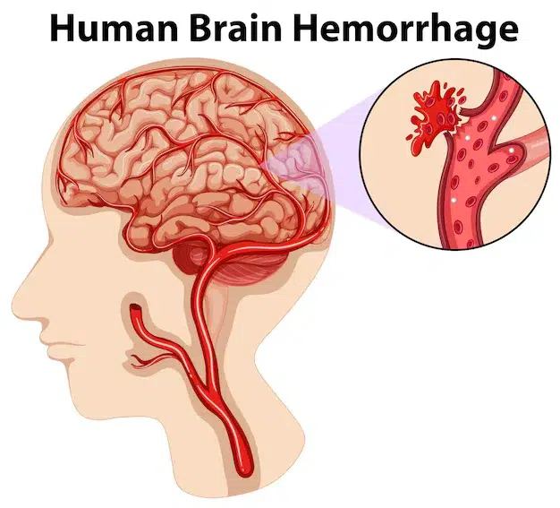 Bleeding In The Brain