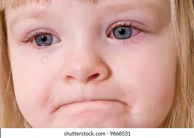 Conjunctivitis