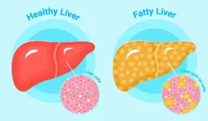 Fatty Liver