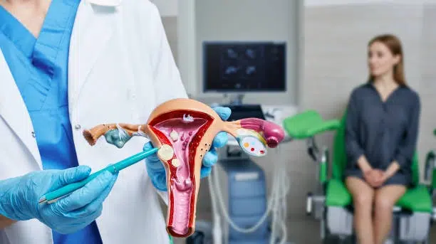 Fibroids