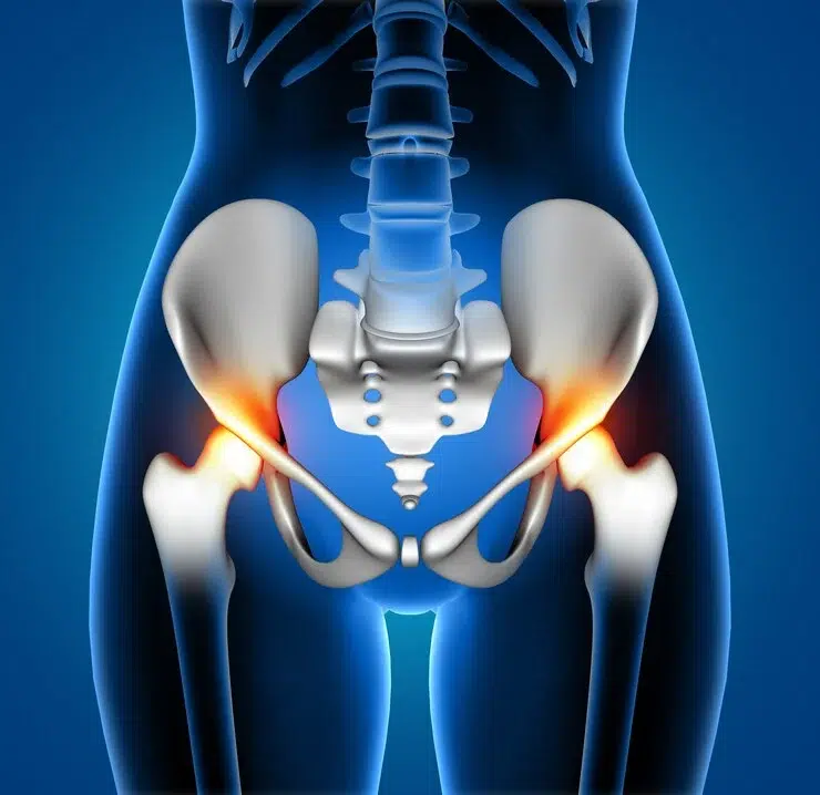 Hip Dysplasia