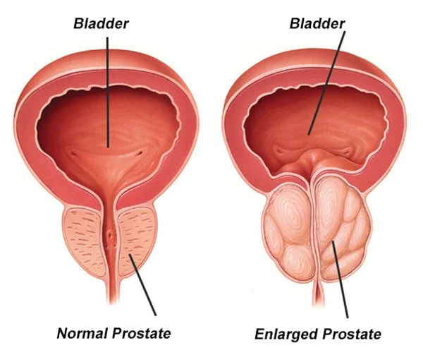 Benign Prostate Hyperplasia