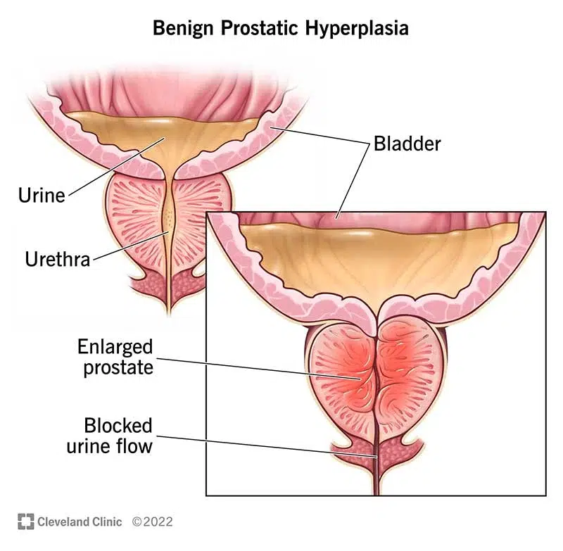Benign Prostate Hyperplasia