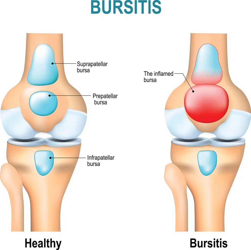 Bursitis