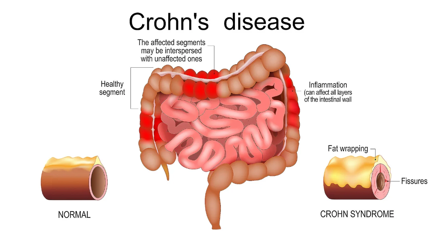 Crohn's Disease