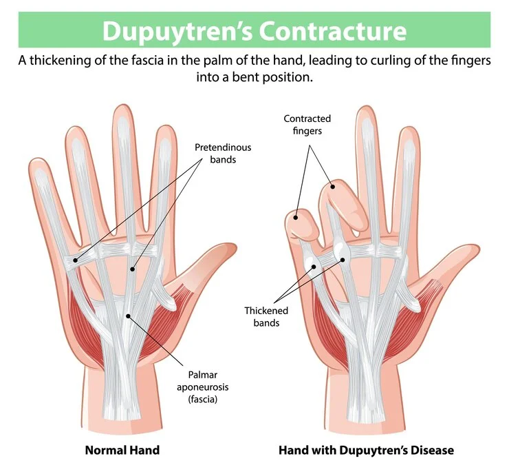 Dupuytren’s Contracture