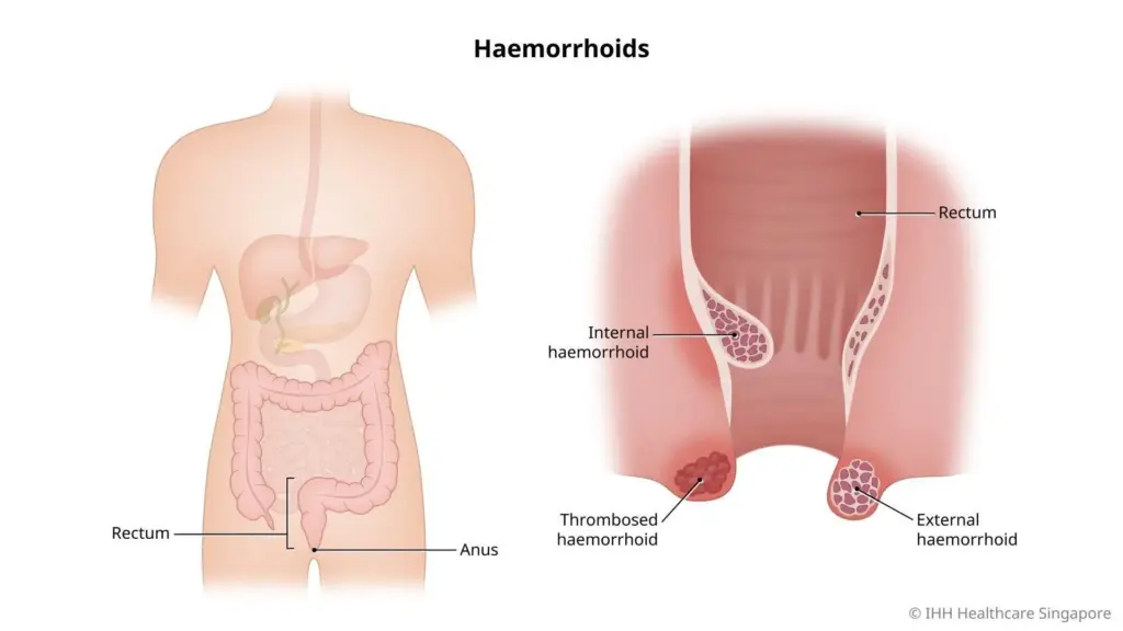 Haemorrhoids