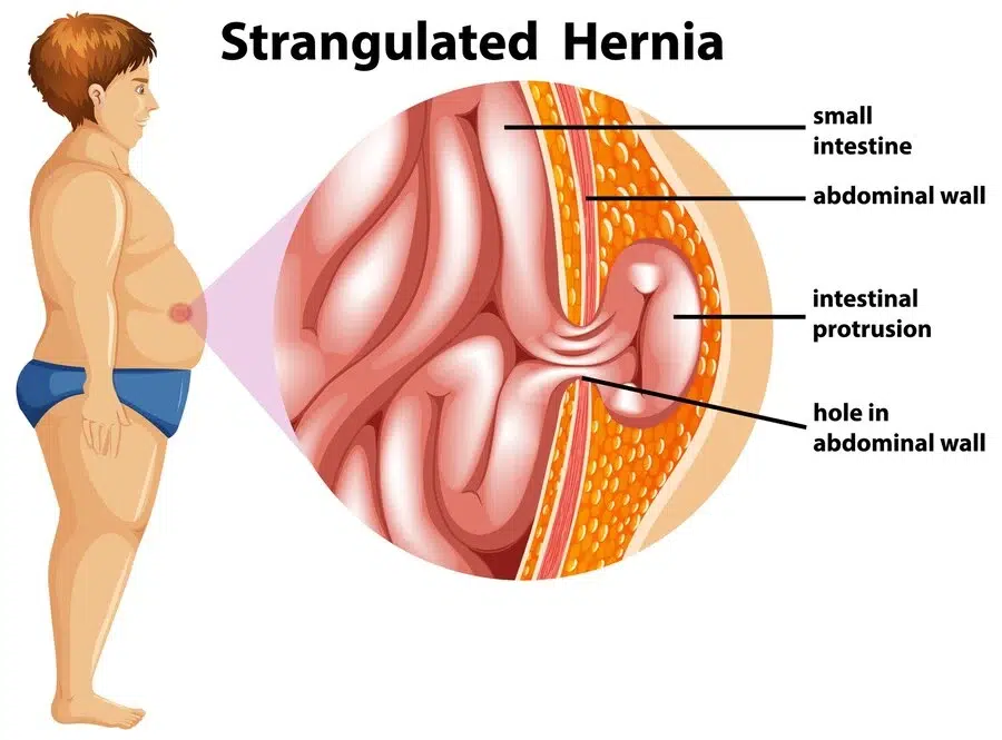 Hernia