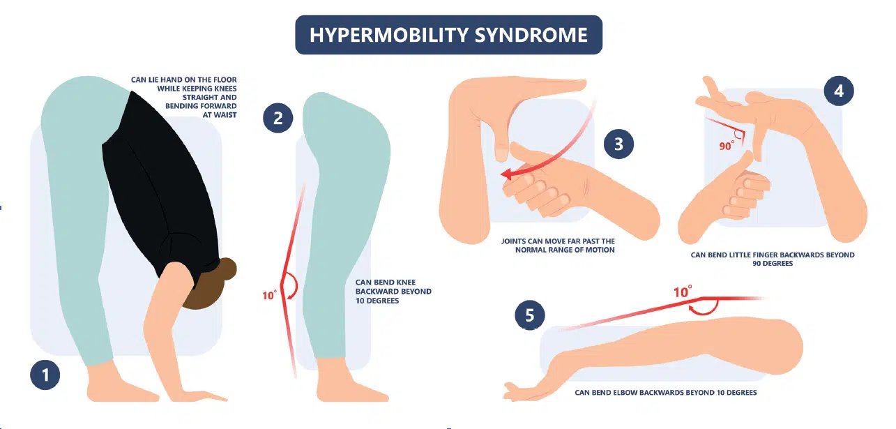 Hypermobility