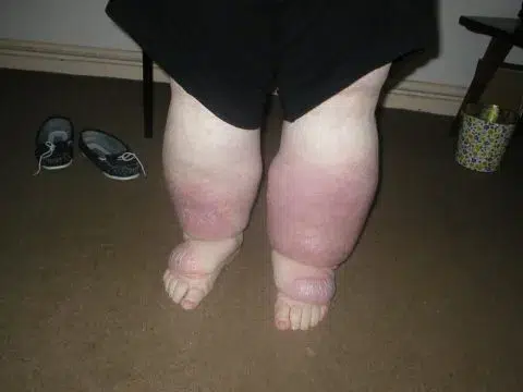 Lymphoedema