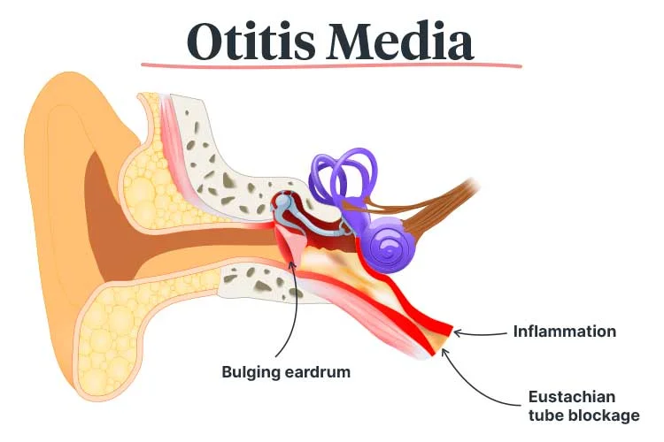 Otitis Media
