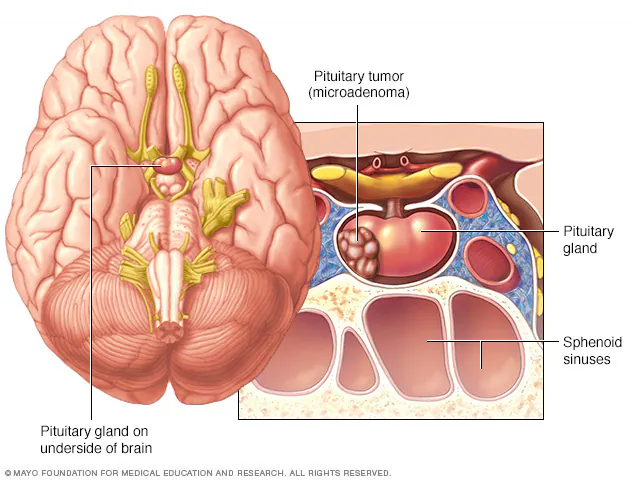 Pituitary Tumours