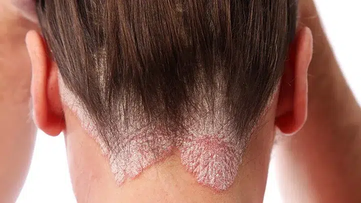 Psoriasis