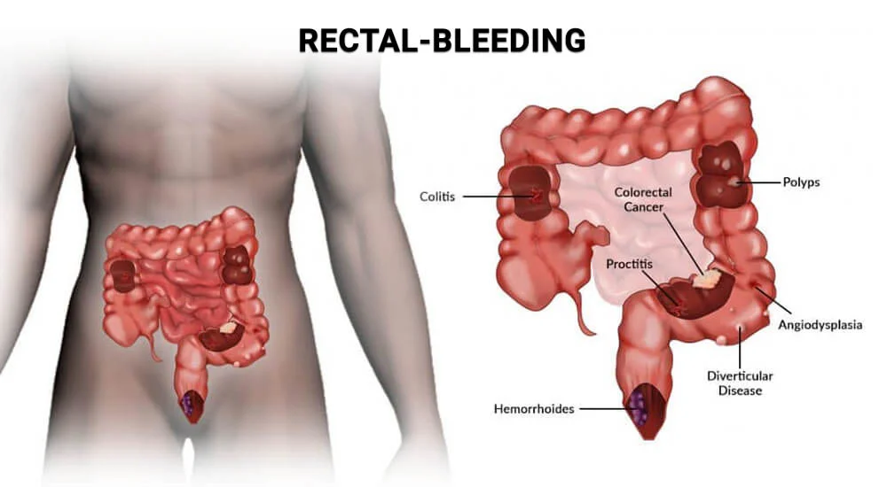 Rectal Bleeding