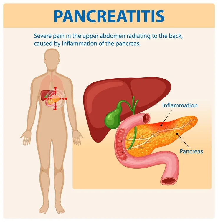 Understanding Pancreatitis