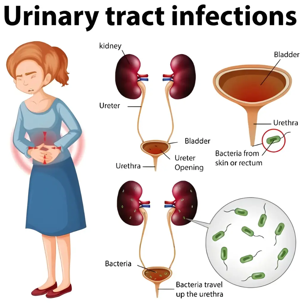 Urinary Tract Infections